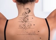 tattoo removal sessions progress photo 6