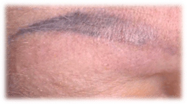 Brow Tattoo Removal (Before)