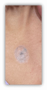 Bullseye Tattoo Removal (After1)