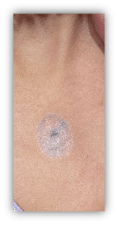 Bullseye Tattoo Removal (After1)