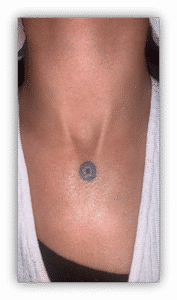 Bullseye Tattoo Removal (Before1)