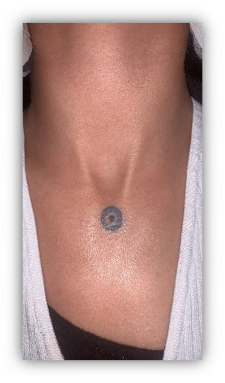 Bullseye Tattoo Removal (Before1)