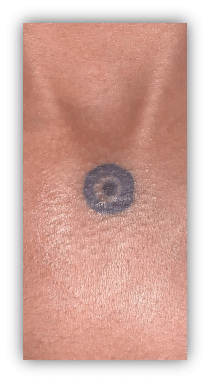Bullseye Tattoo Removal (Before2)