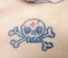 Skull Tattoo Removal (Before)